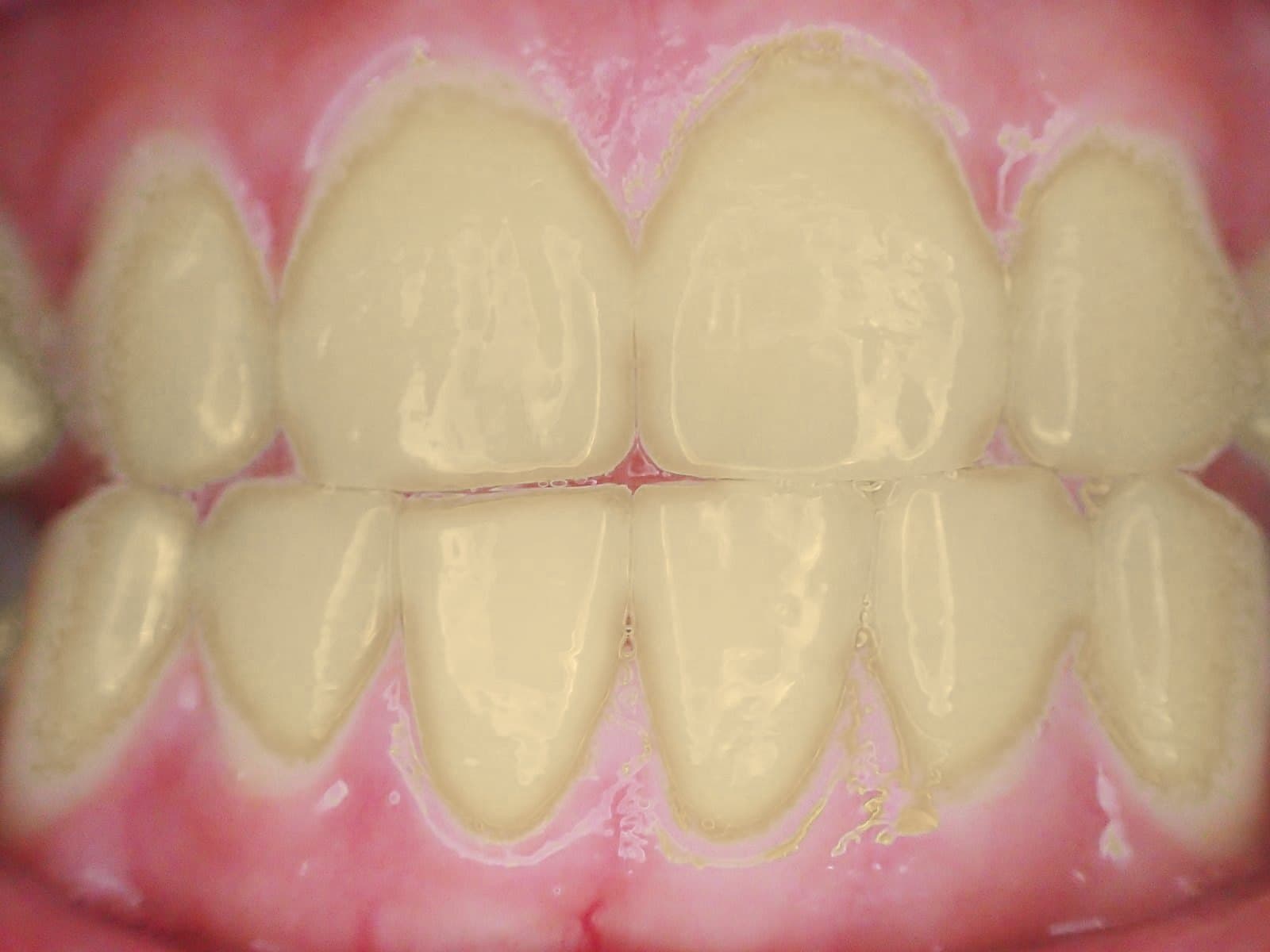 Yellowed, stained front teeth before whitening (simulated)